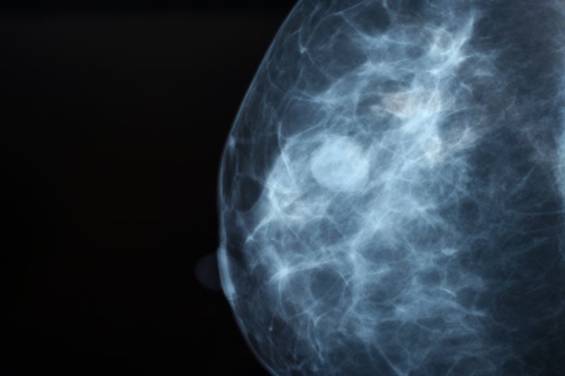 Closeup of breast image