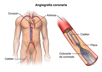 El cuerpo de un hombre con un catéter insertado en la pierna y llega hasta una arteria del corazón. Se inyecta un colorante.